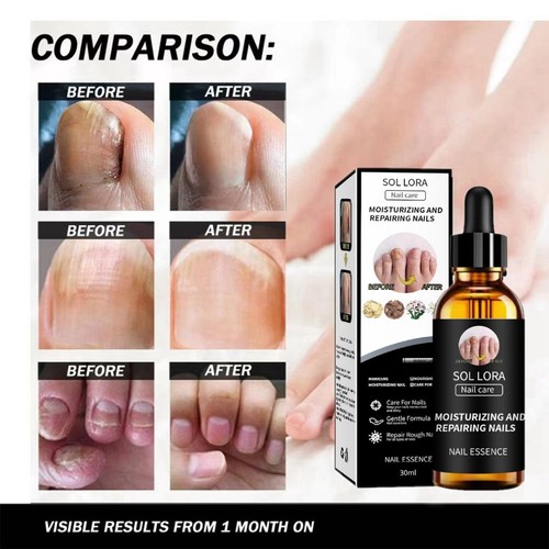 Nail fungus treatment - fungus,
